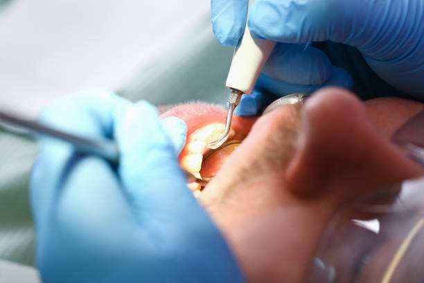 Best Emergency Root Canal Treatment in Maynardville, TN