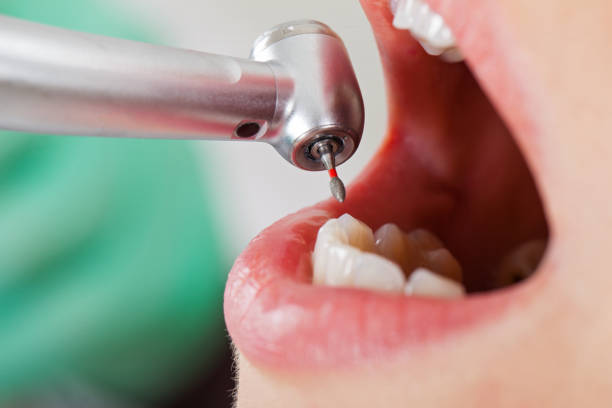 Best Broken or Cracked Tooth Emergency Dentist in Maynardville, TN